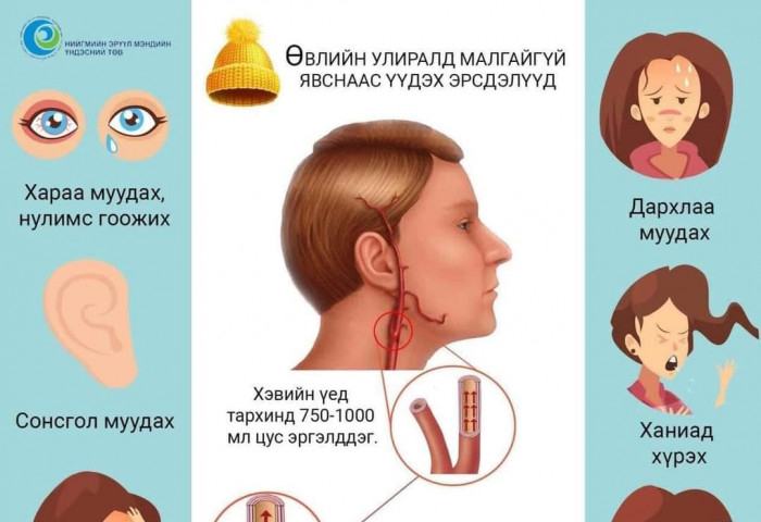 Өвлийн улиралд малгай өмсөхгүй байх нь сонсгол муудахад нөлөөлнө